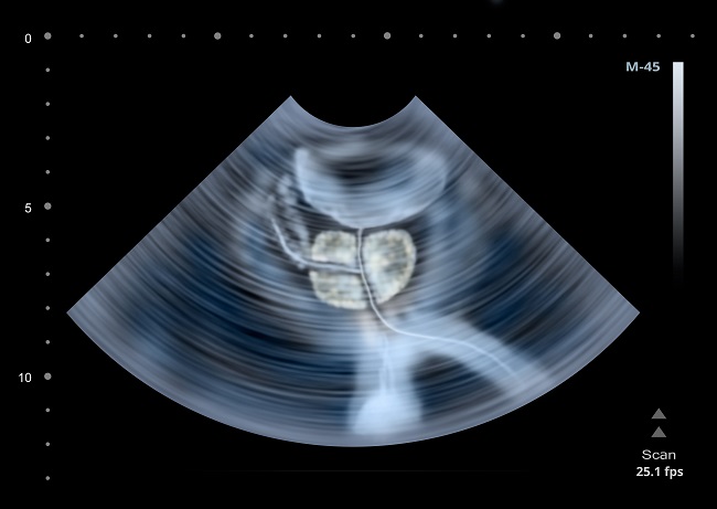 hypertrophie bénigne de la prostate